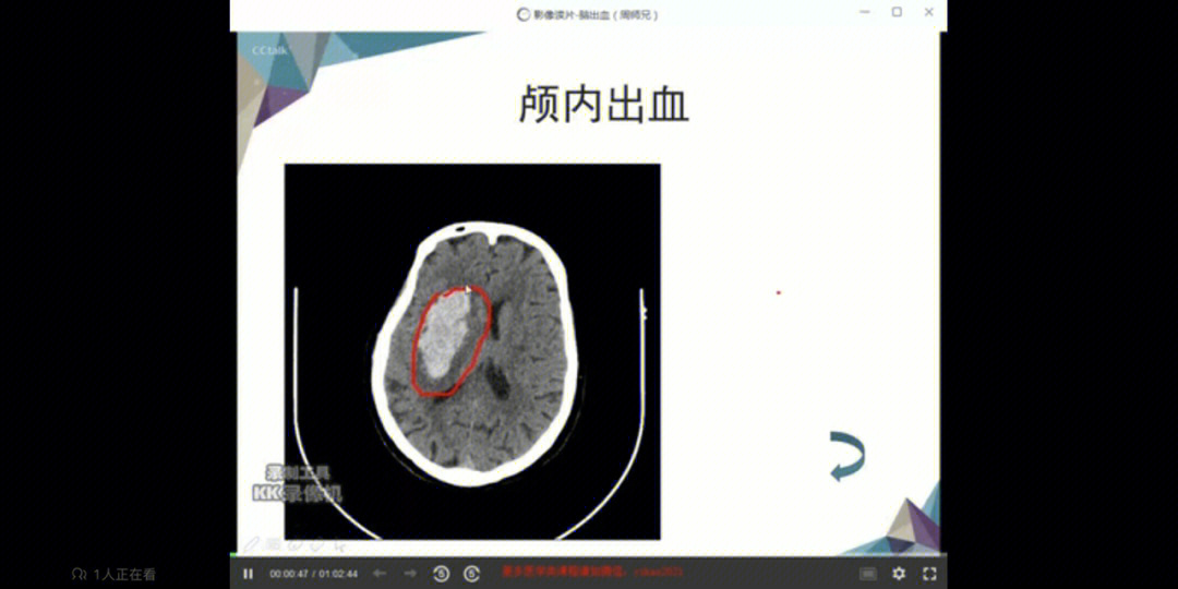 侧脑室后角出血图片