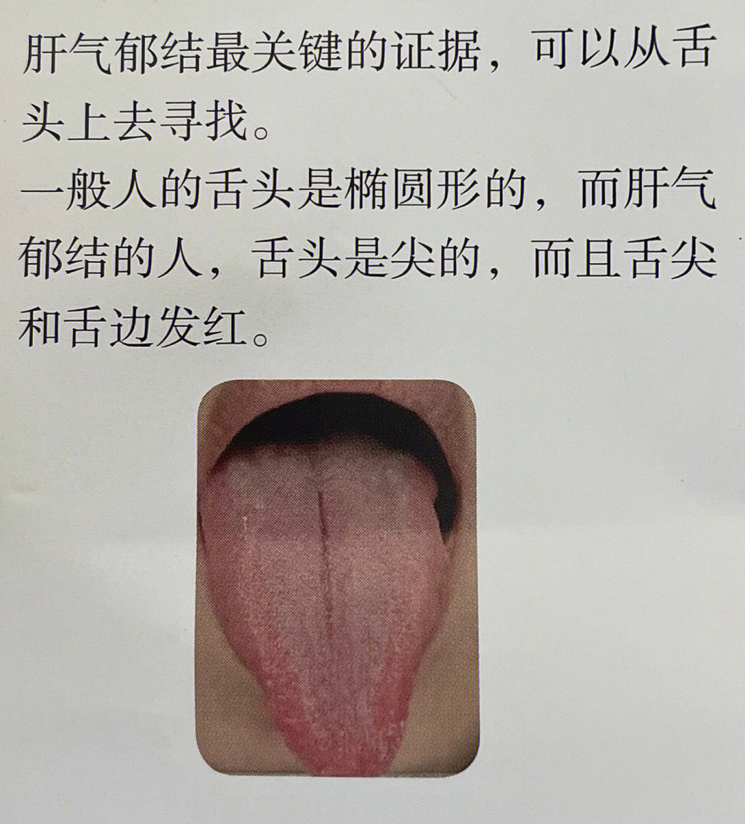 肝气郁结最关键的证据,可以从舌头上去寻找