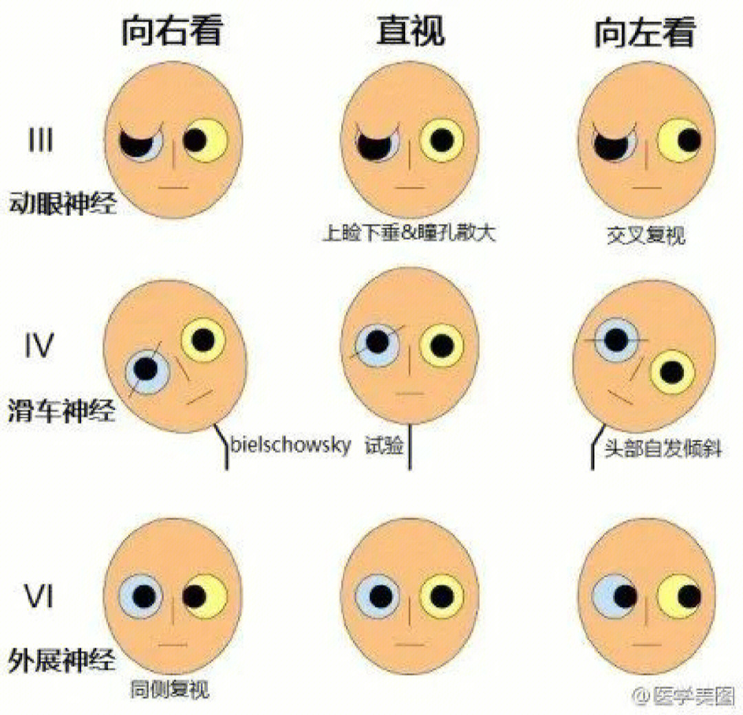 动眼神经,滑车神经和外展神经损伤的鉴别2不同部位脑病的瞳孔变化3