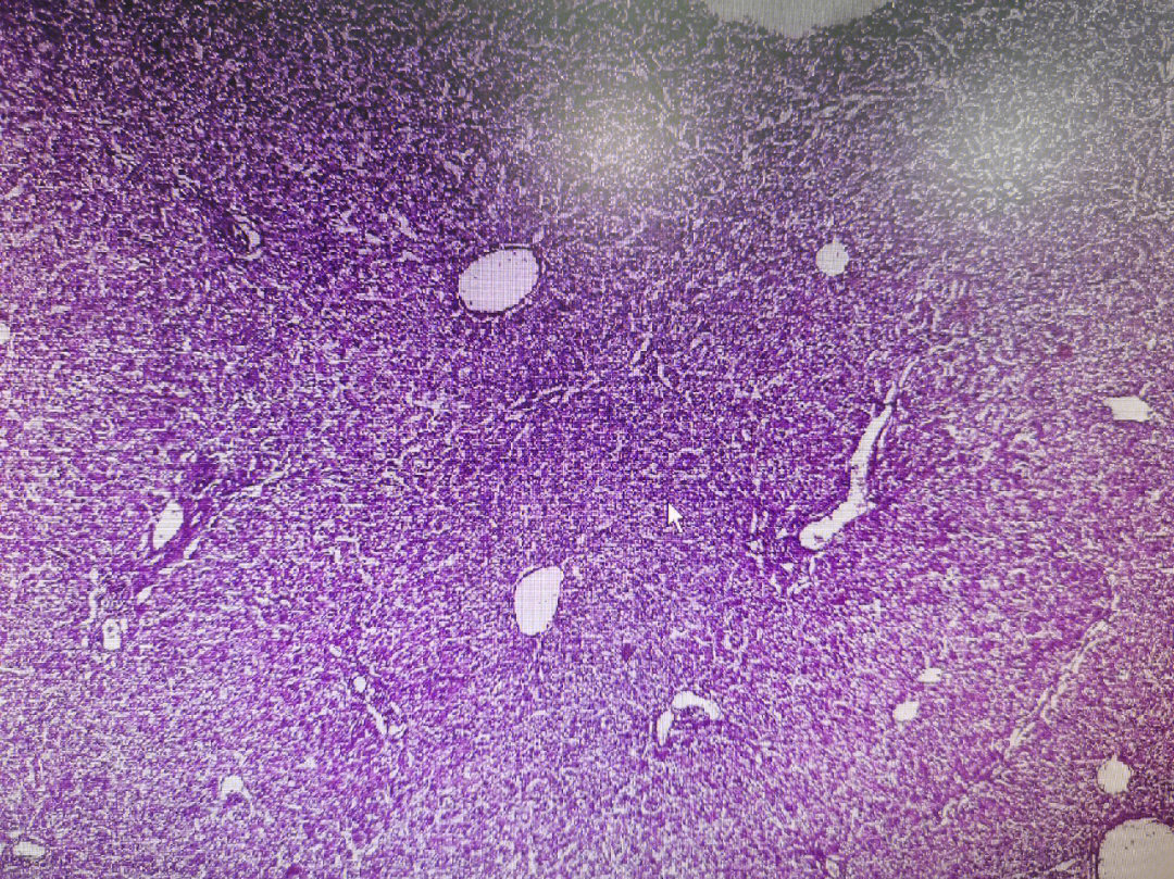 这是一张肝细胞水肿的he染色切片