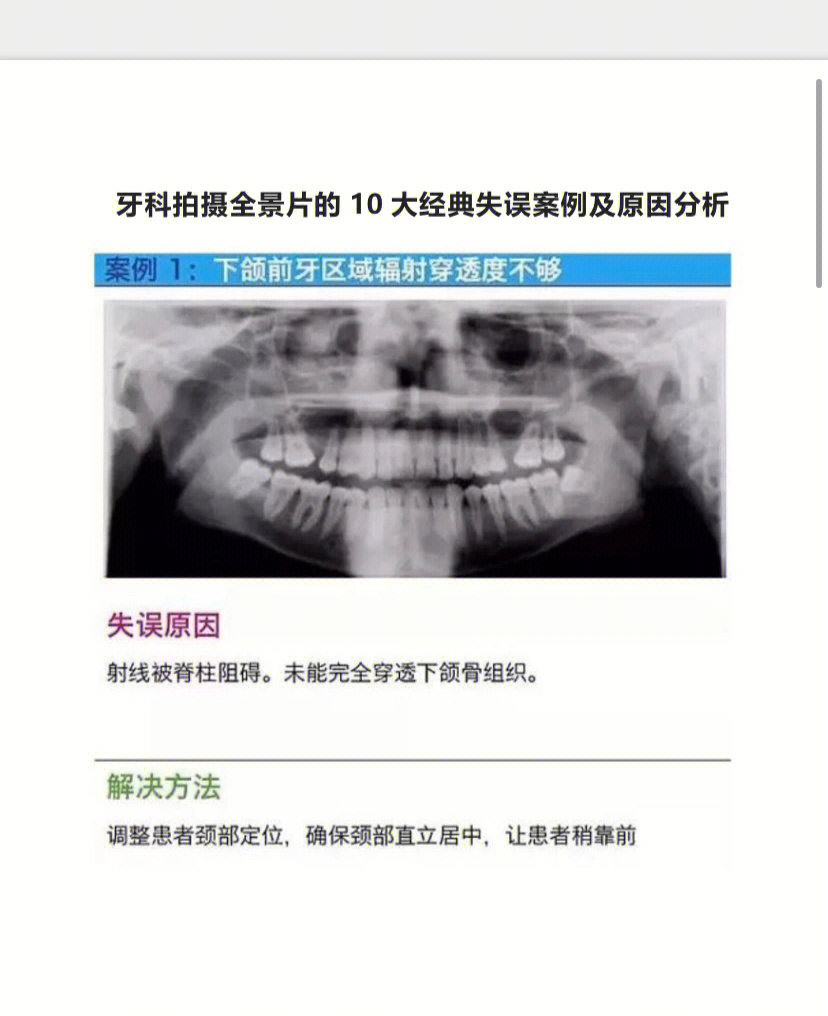 口腔全景片看分解图图片