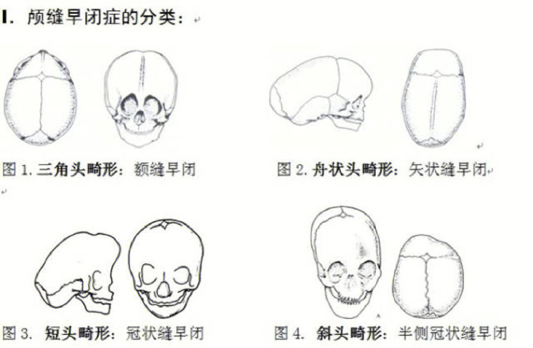 胎儿冠状缝图片图片