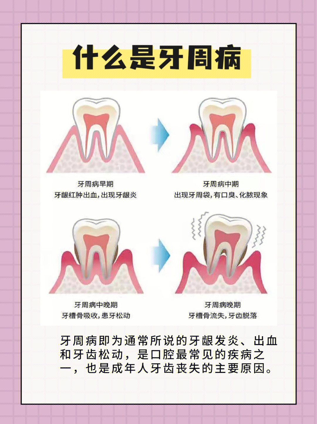 牙周炎怎么治疗好得快图片