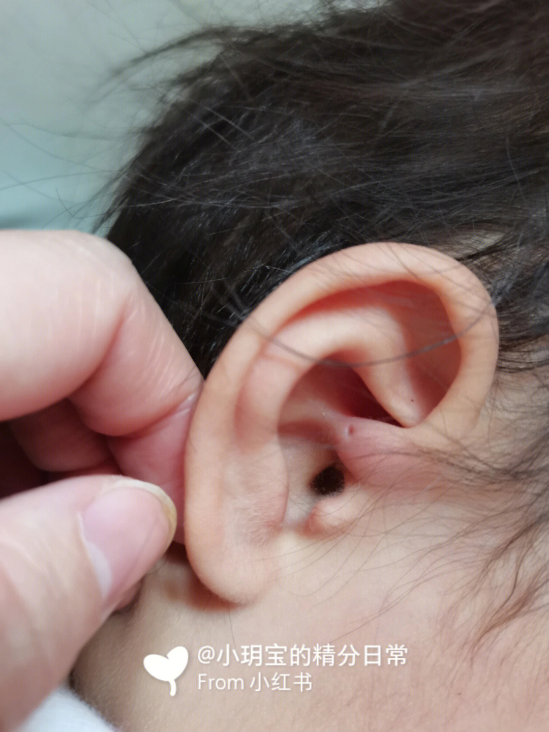 先天性耳瘘图片图片