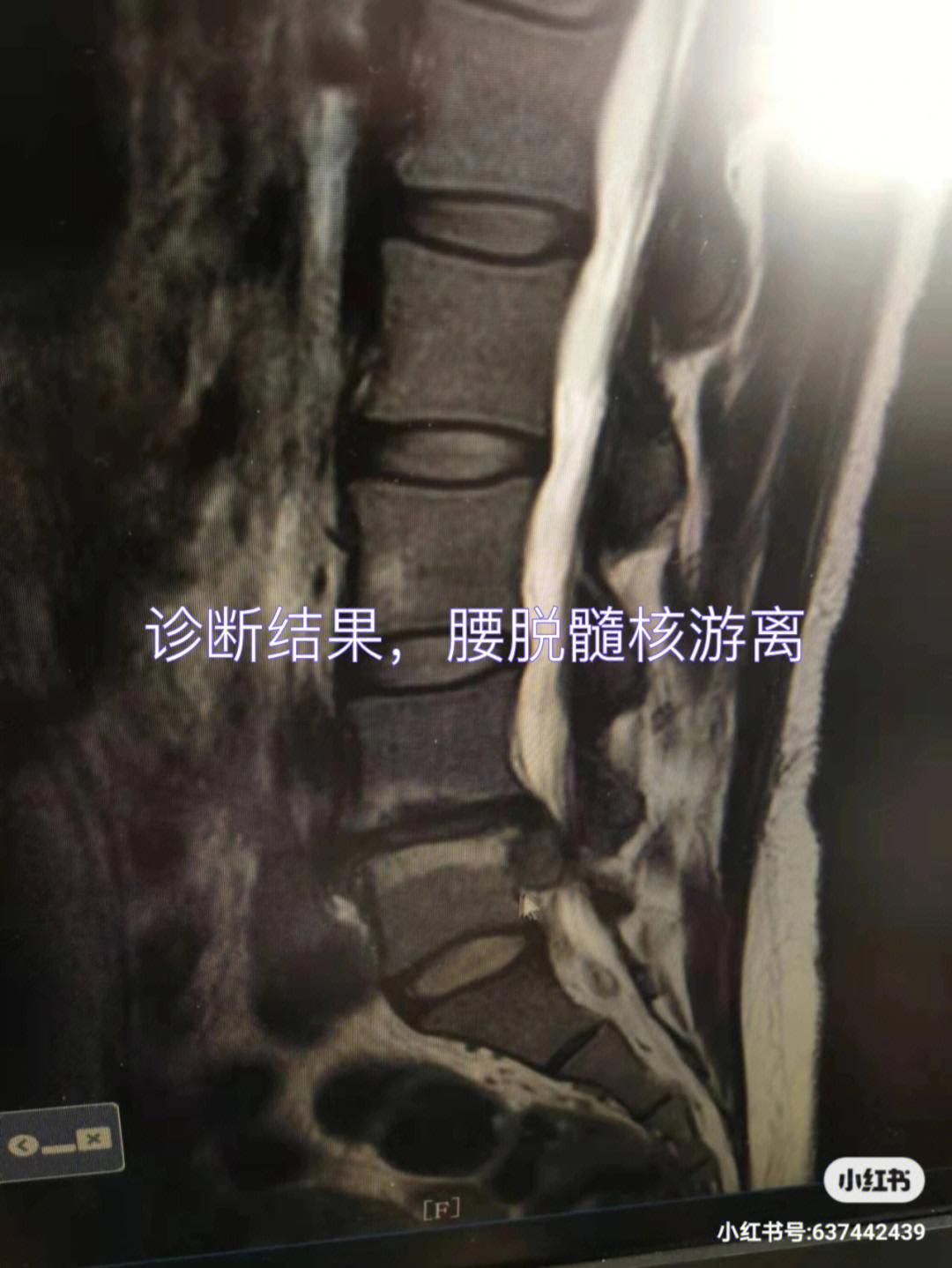 腰脱髓核游离,保守治疗成功