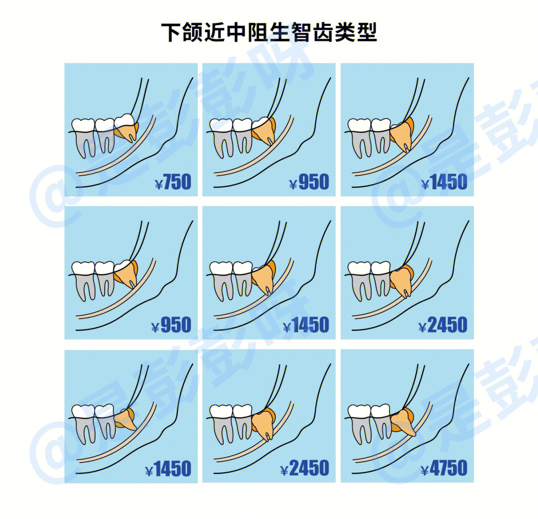 拔智齿难易程度排序图片