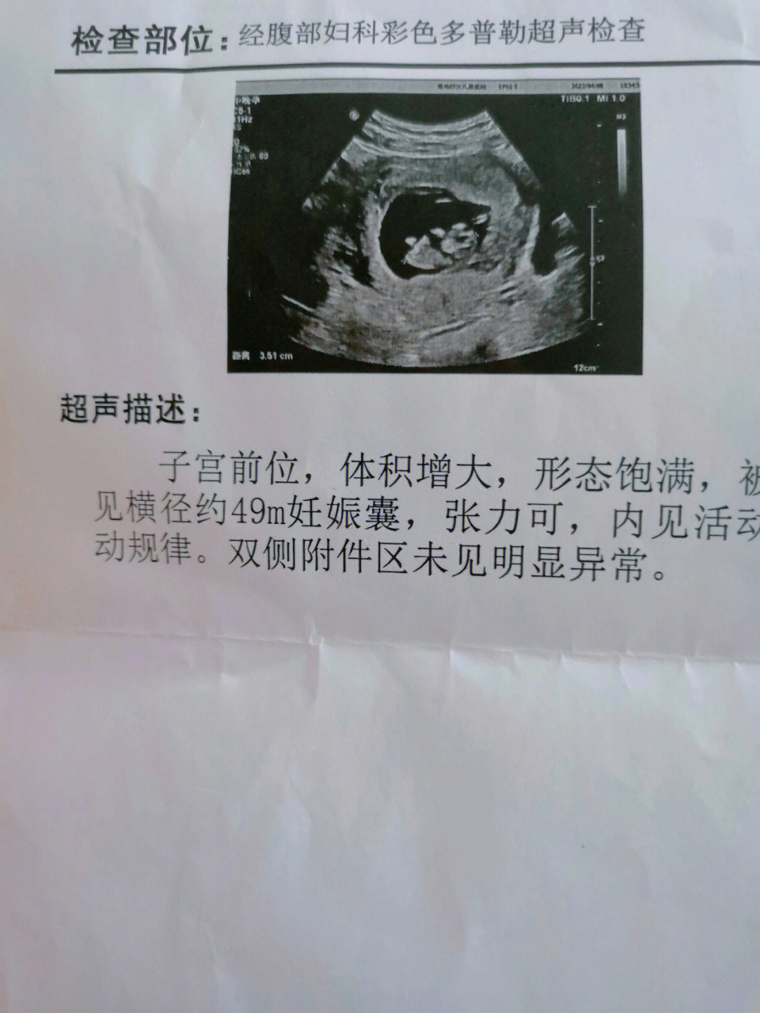 怀孕10周男孩孕囊图图片