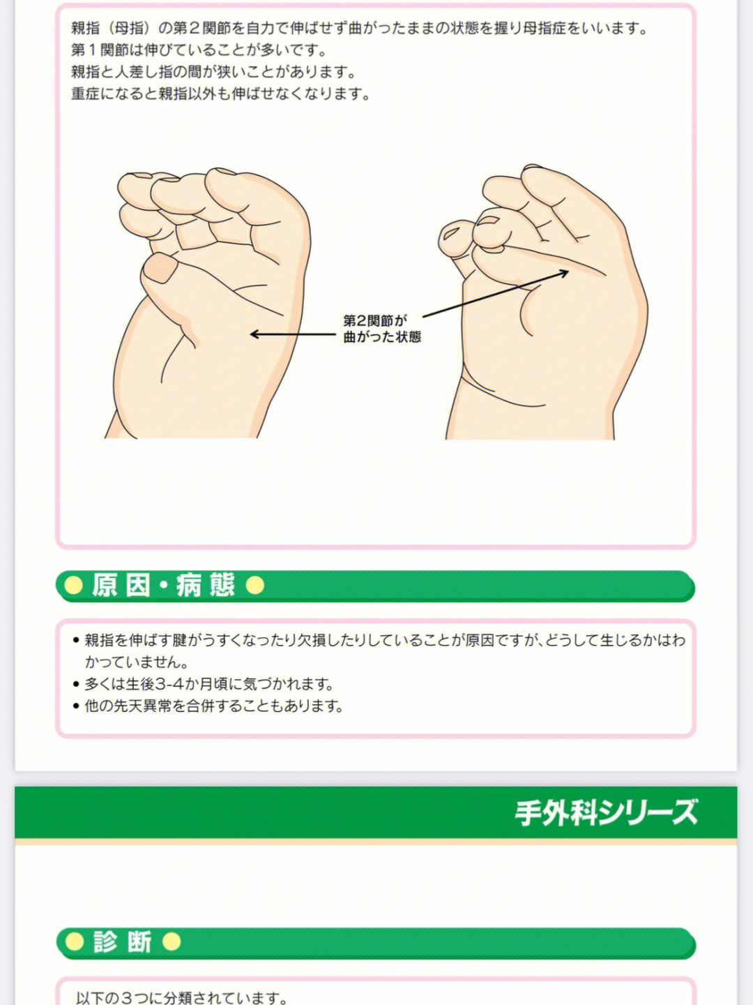 在日本宝宝拇指内扣矫正及扁平足改善锻炼法