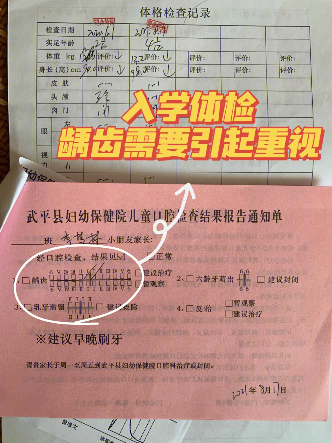 入学体检龋齿需要引起重视