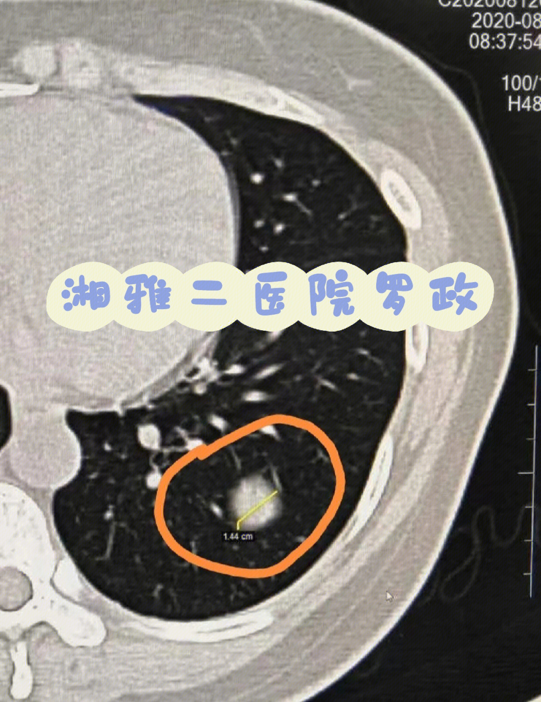 磨玻璃结节切除图片