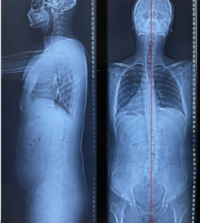 案列分享30岁了脊柱侧弯还能矫正