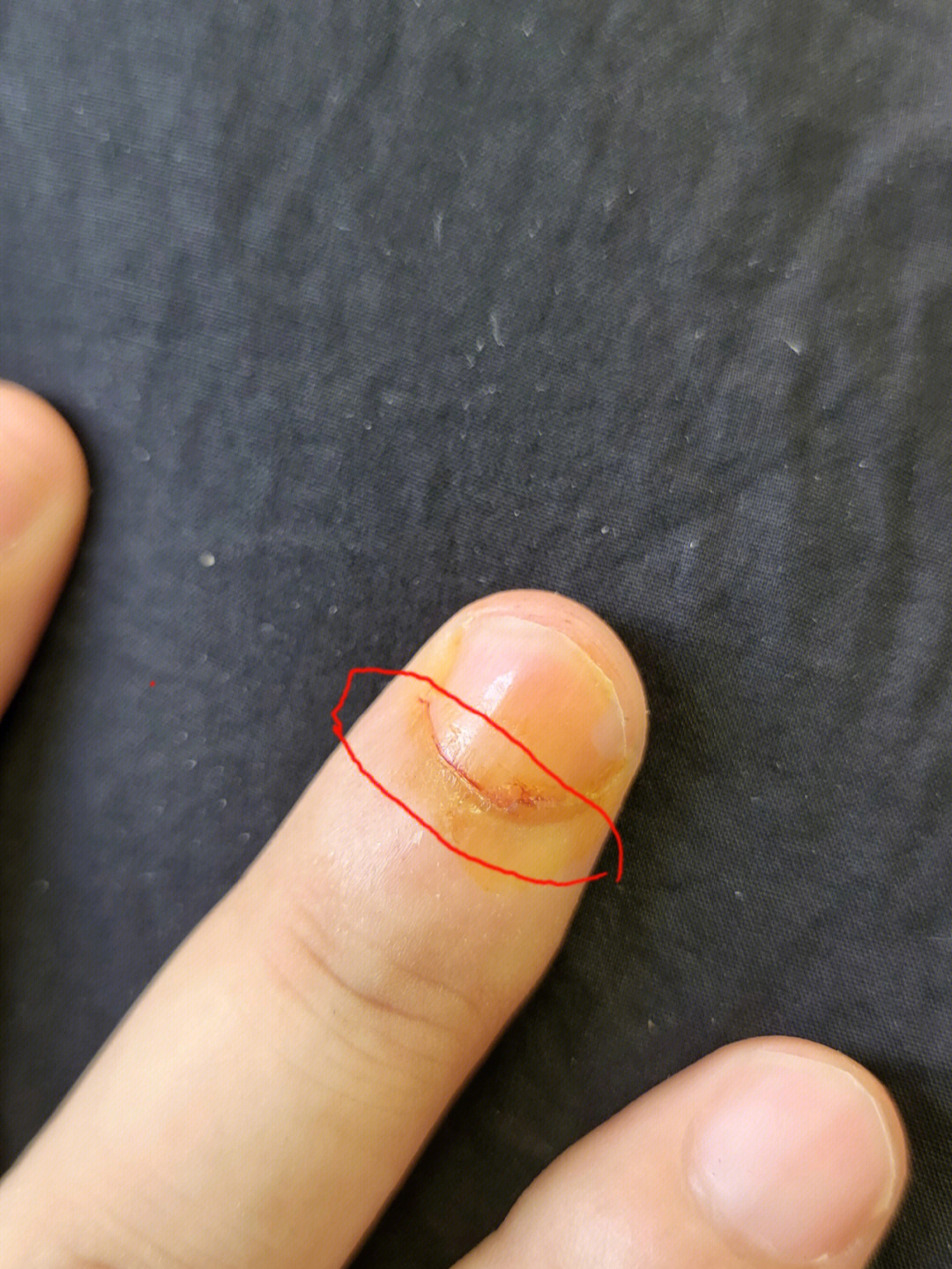 指甲根部被刀切开了会不会影响指甲生长