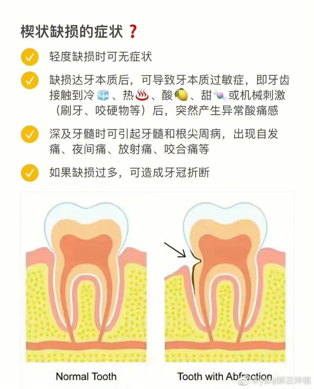 楔状缺损备洞形图解图片