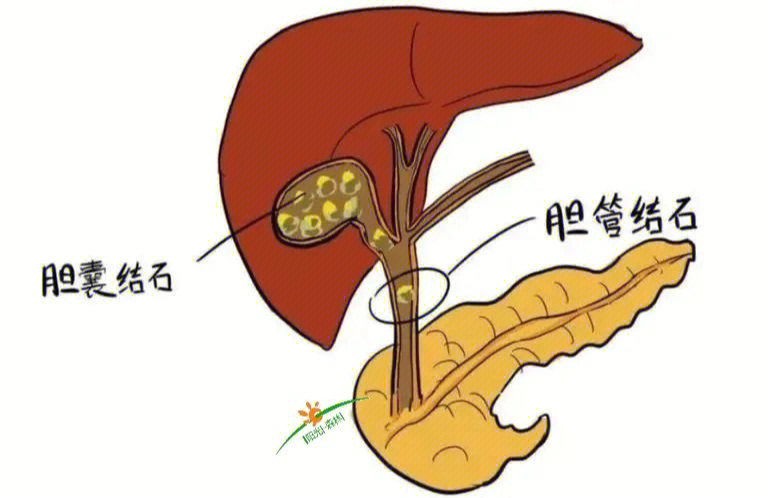 哪些人最容易得胆结石呢