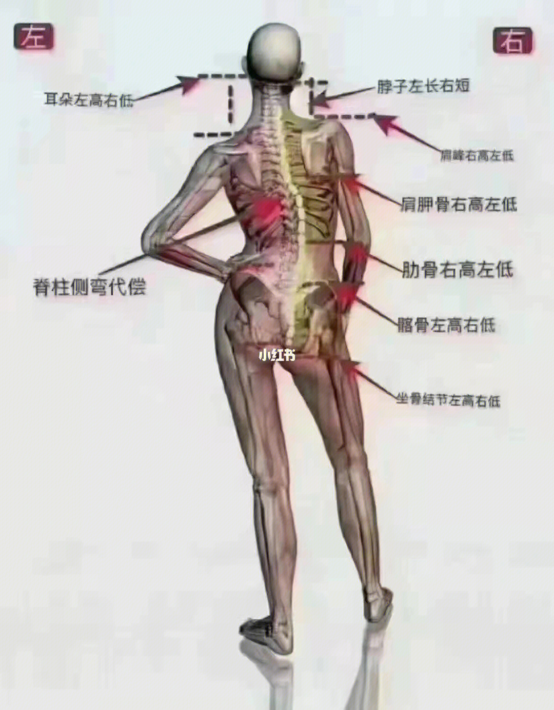 骨盆左高右低矫正图解图片