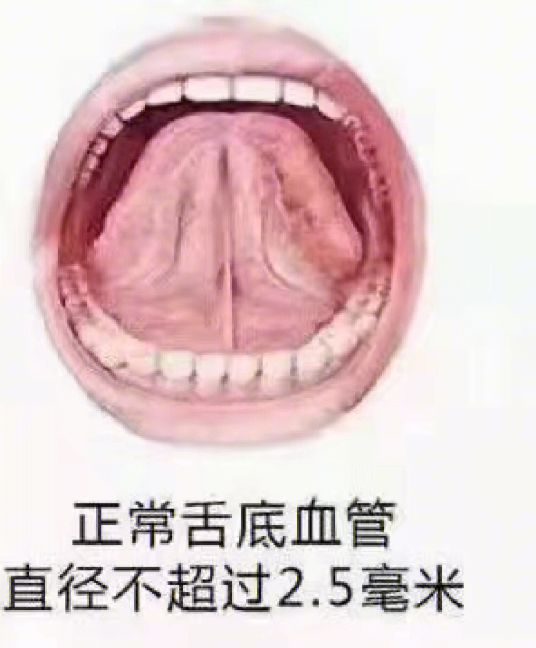 舌诊 黄燥苔:成因有数种: (1)苔薄黄而干,为病初外邪化热入里,邪热伤