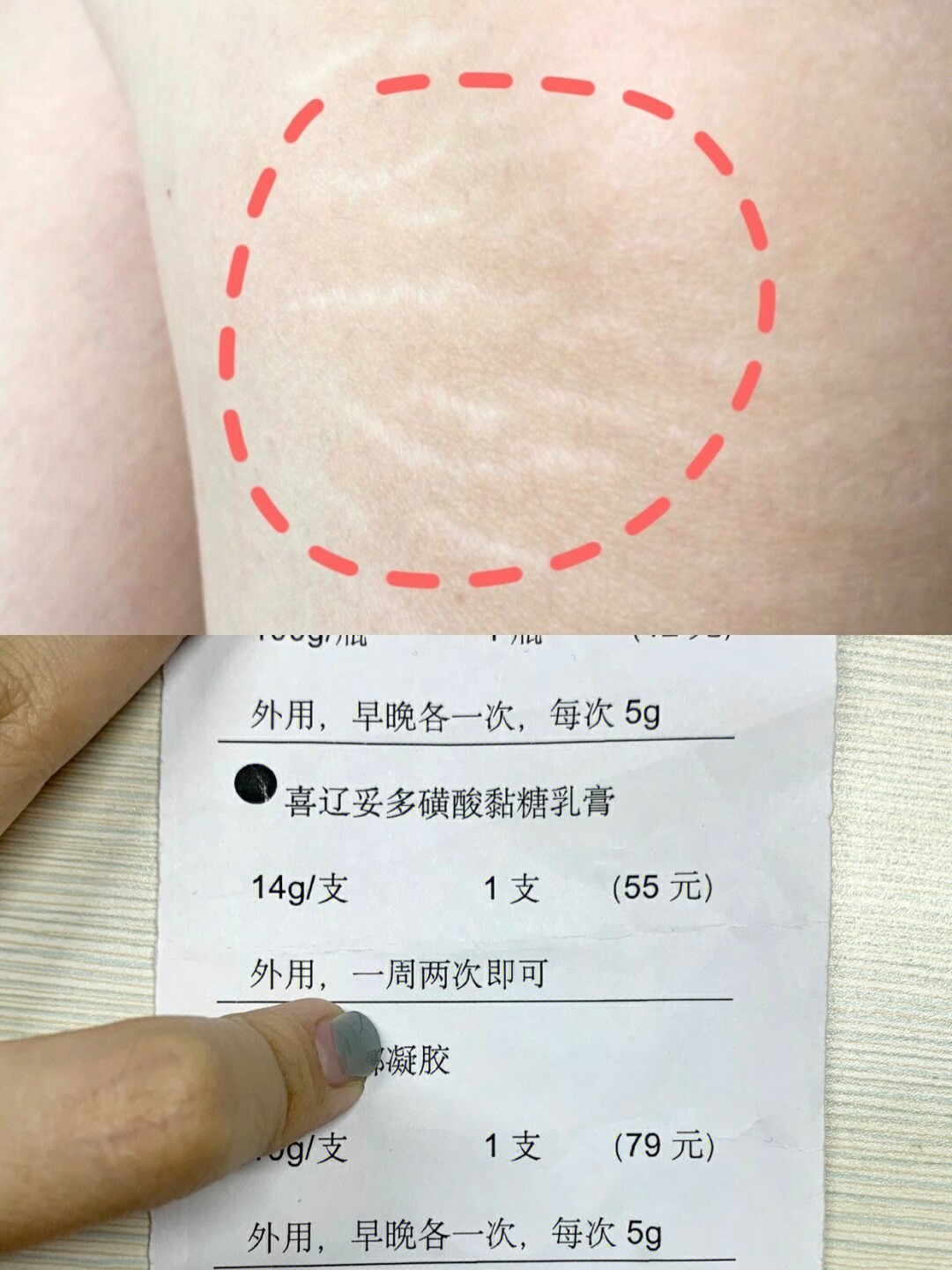 肥胖纹怎么消除 去掉图片