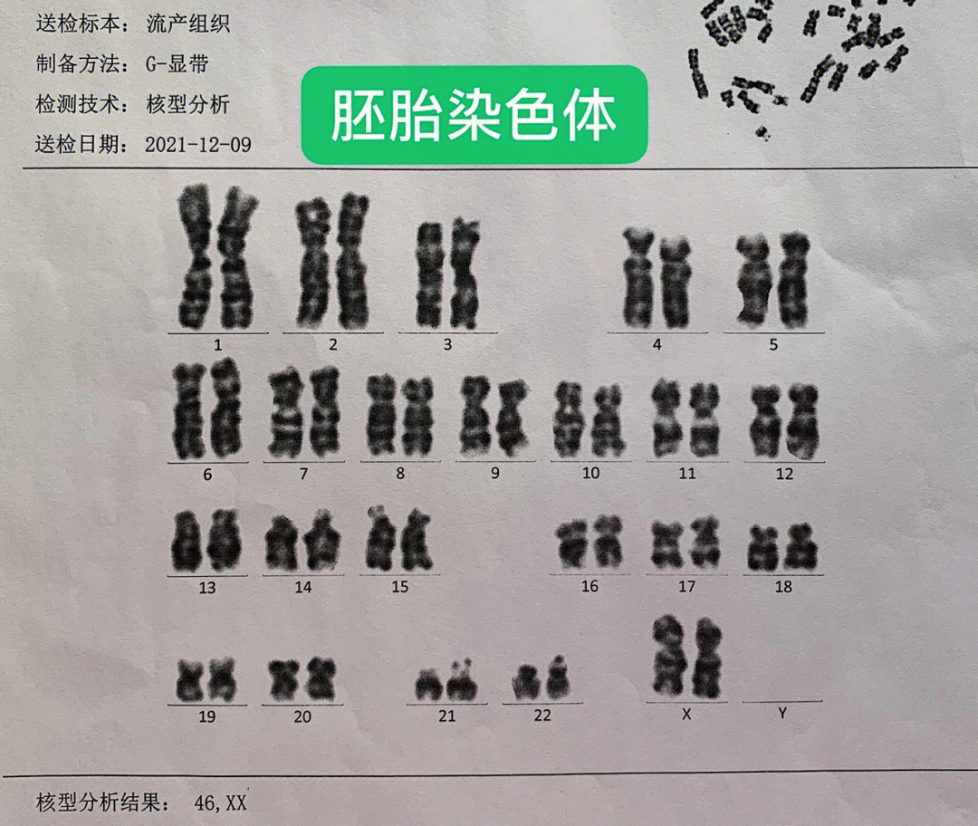 孕前检查染色体图片