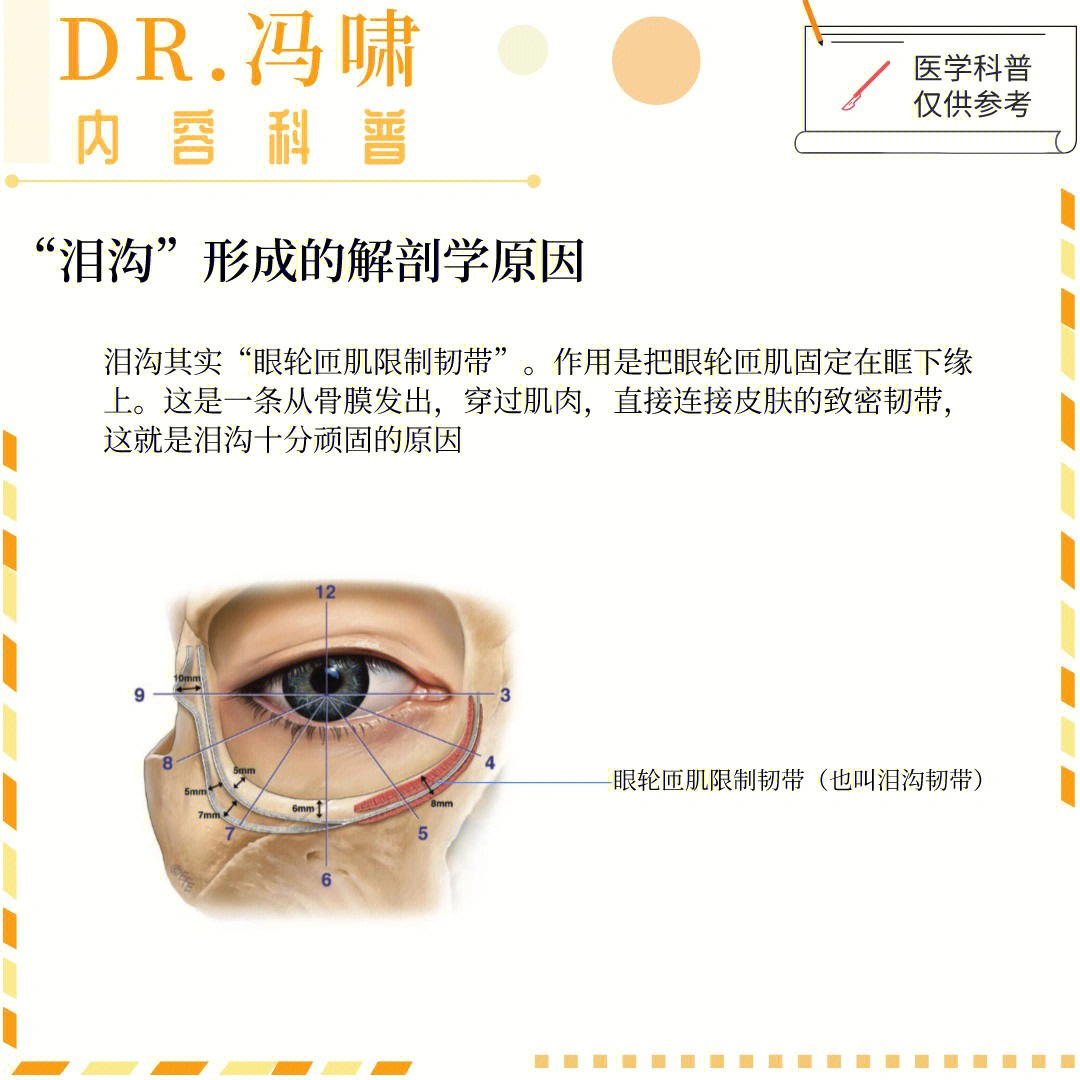 泪沟型眼袋形成的原因图片