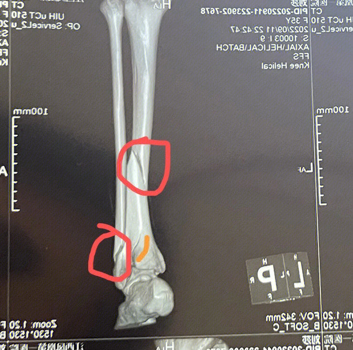 胫腓骨中段骨折图片