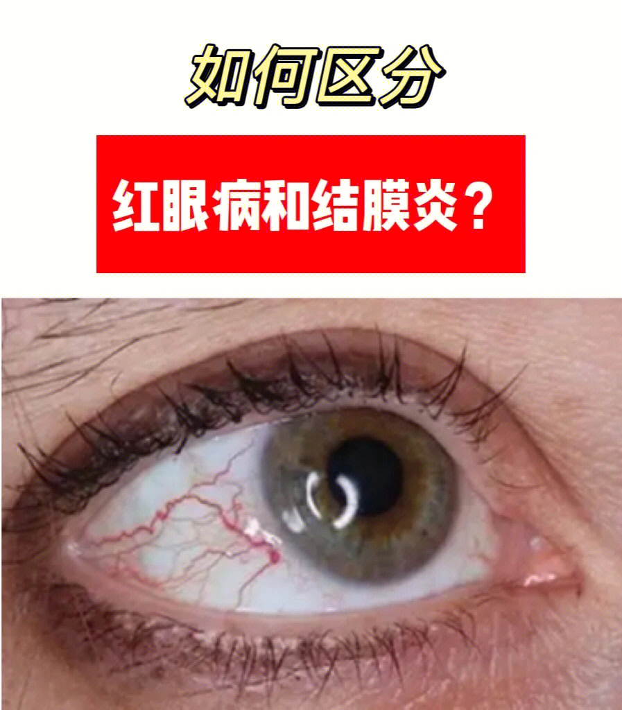 眼睛血丝多的原因图片