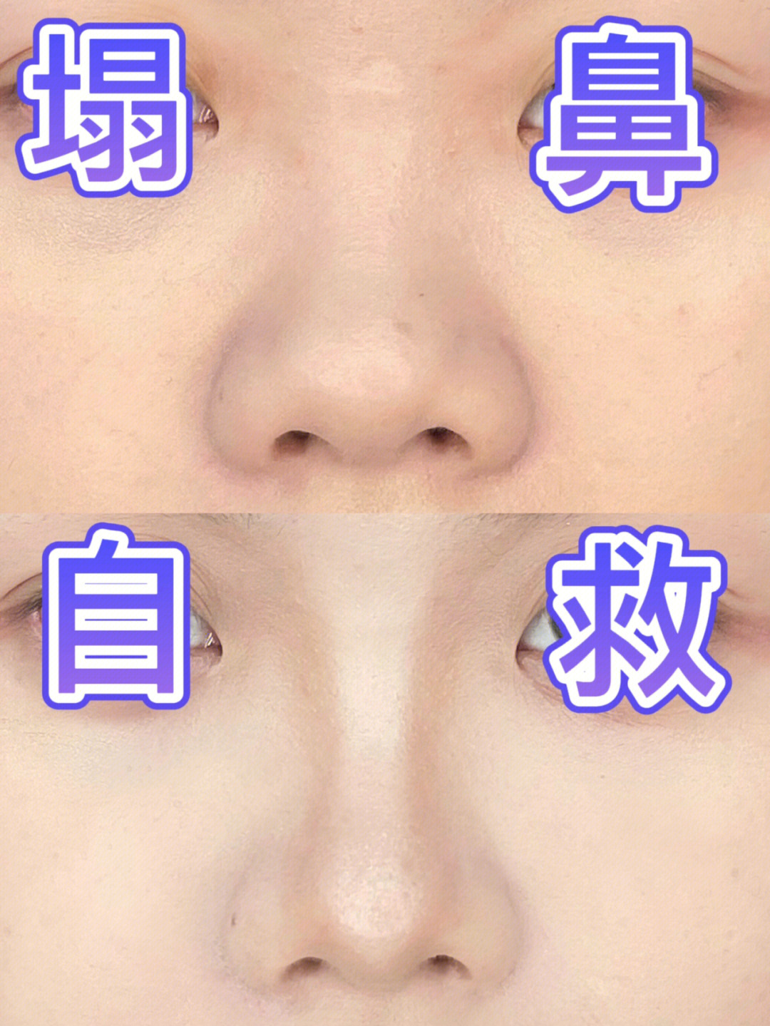 悬胆鼻和蒜头鼻的区别图片