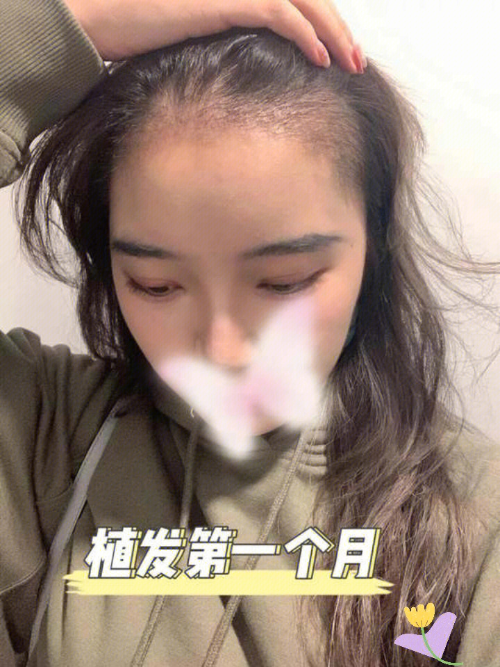 不剃发植发真的让我更自信了