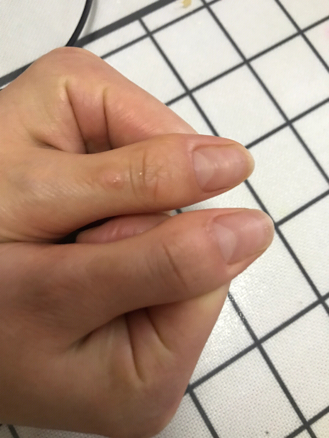 一样凹凸不平的,其他的都比较正常就是大姆手指这样,两个都是拇指的