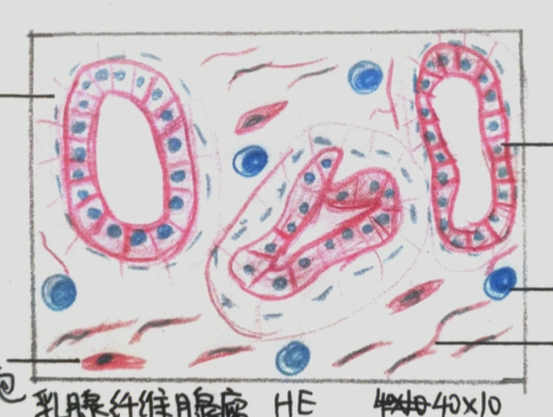 纤维肉瘤绘图图片