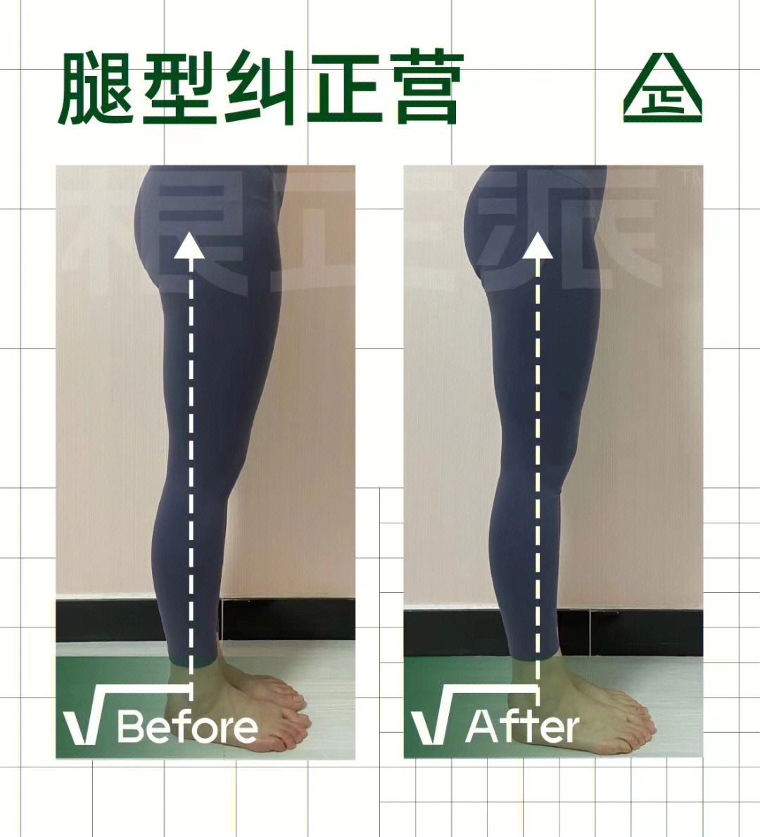 腿课打卡20天～腿型改善很明显,假胯宽减轻了很多,尤其是侧面看