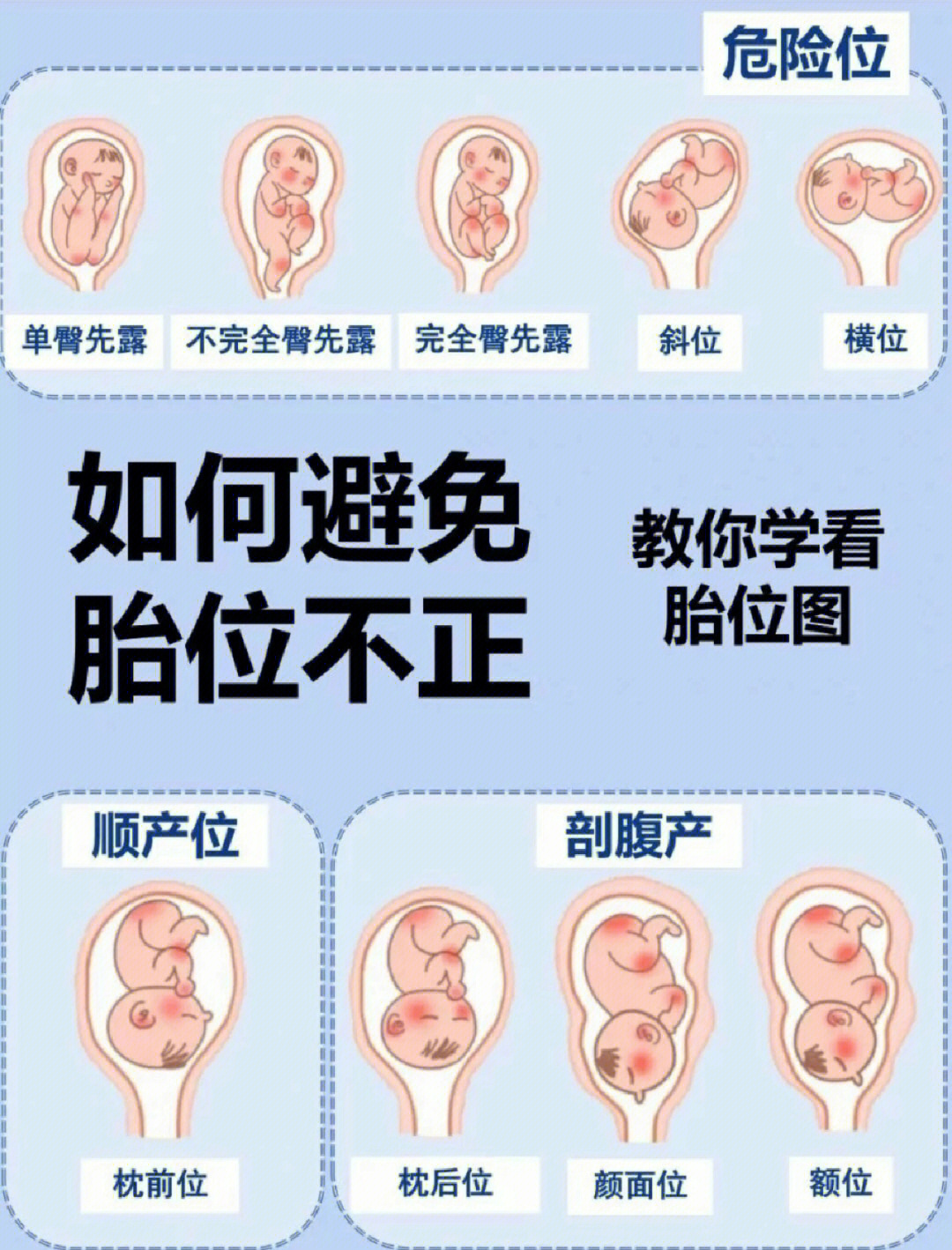 胎位不正纠正方法图片