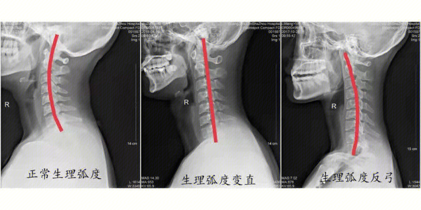 颈椎生理曲度反弓对比图片