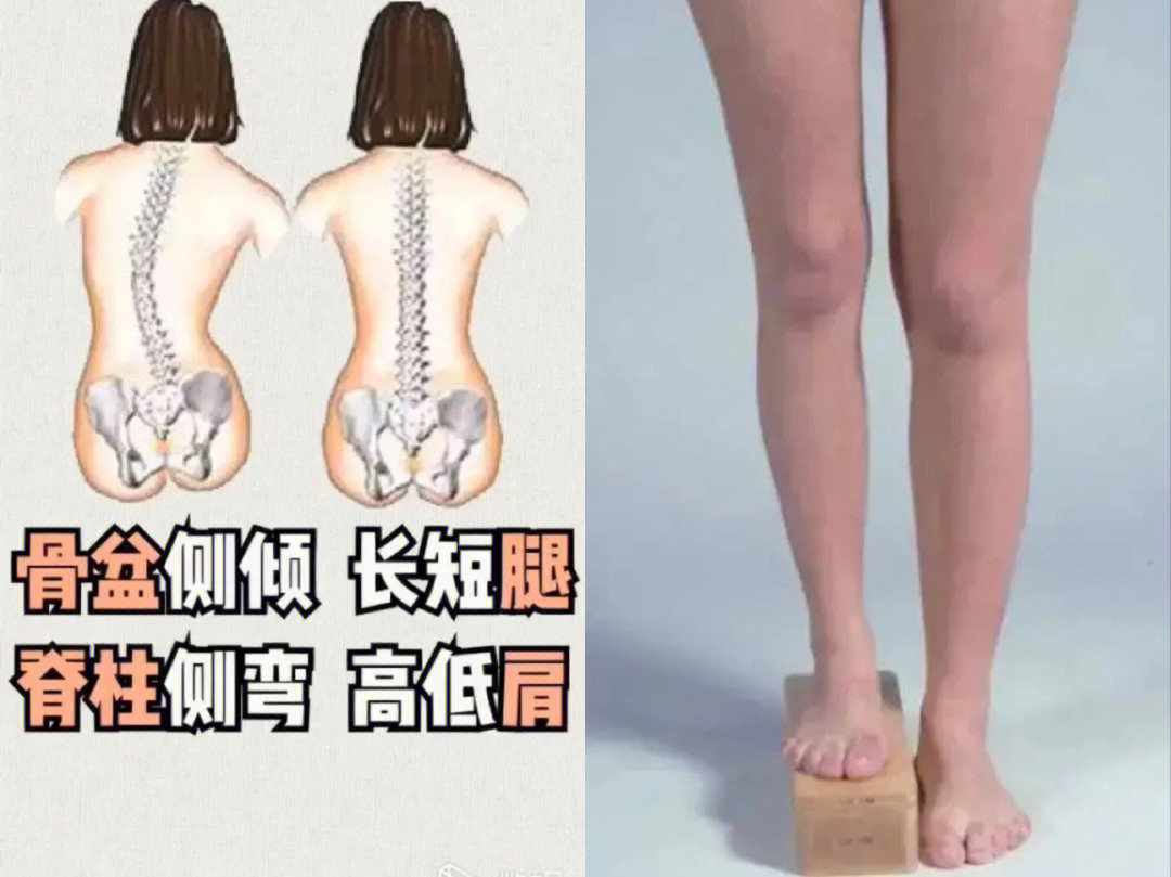 骨盆侧倾型长短腿解决方法如下