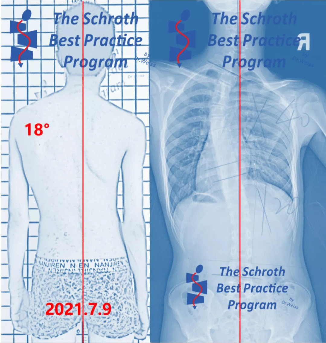 2006年8月出生的男孩,今年7月确诊为特发性青少年脊柱侧弯