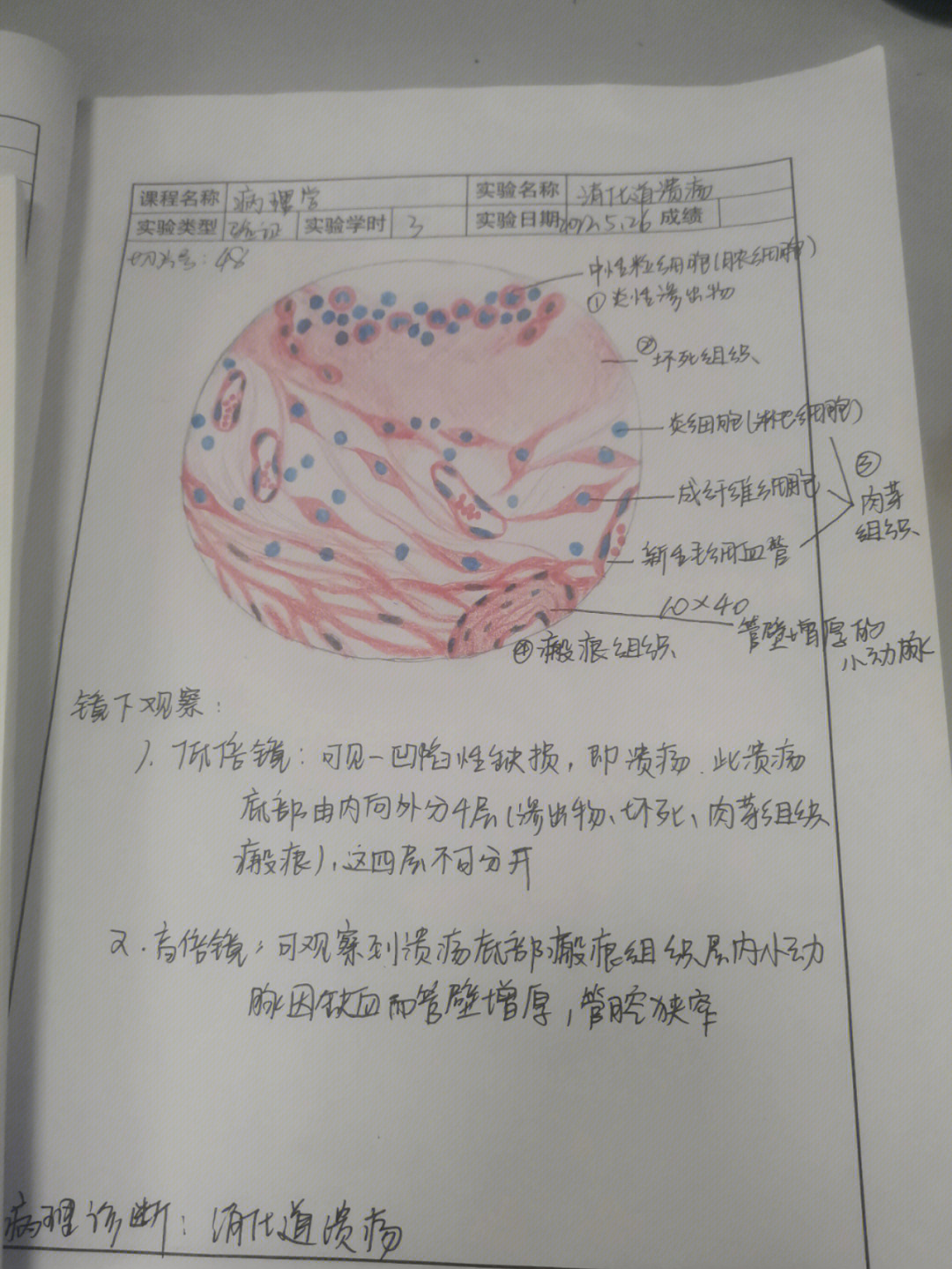 胃粘膜层红蓝铅笔图图片
