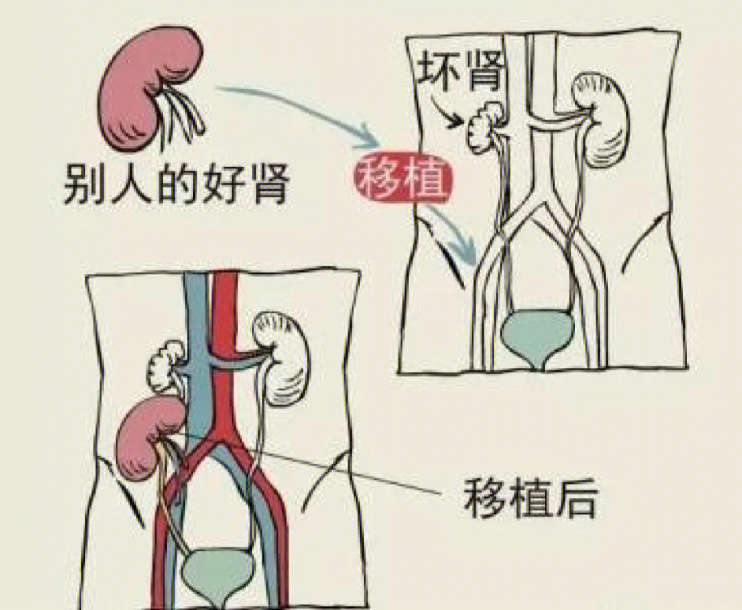 移植肾的位置图片图片