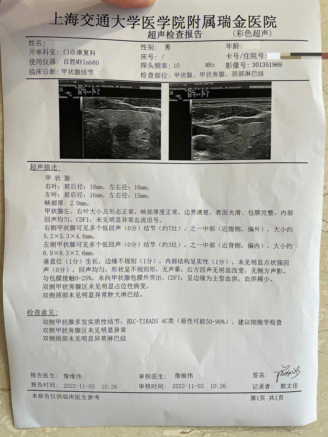 甲状腺穿刺报告解读图片