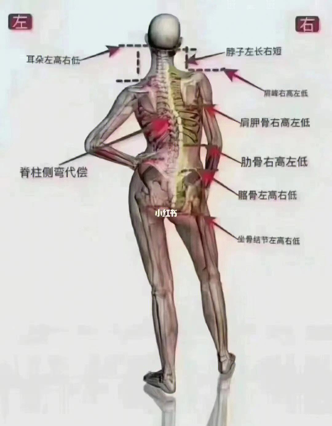 骨盆像水盆歪了或变形,内部的脏器会受牵连,脊柱也被迫变形