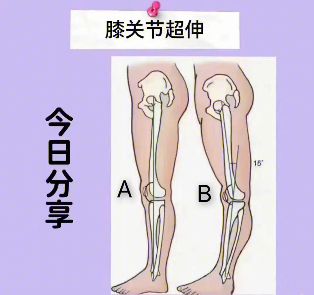 你必须知道的修长腿养成的一步95腿粗减不下去?可能是由于膝超伸哦!