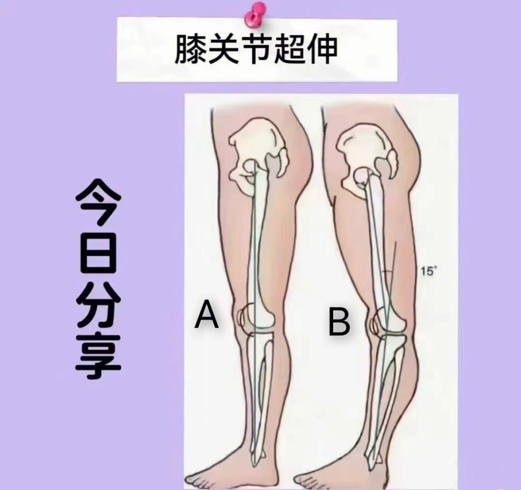 正常膝盖伸直图片图片