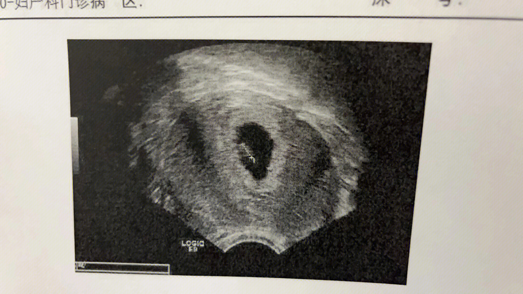 40天胎芽的形状图图片图片