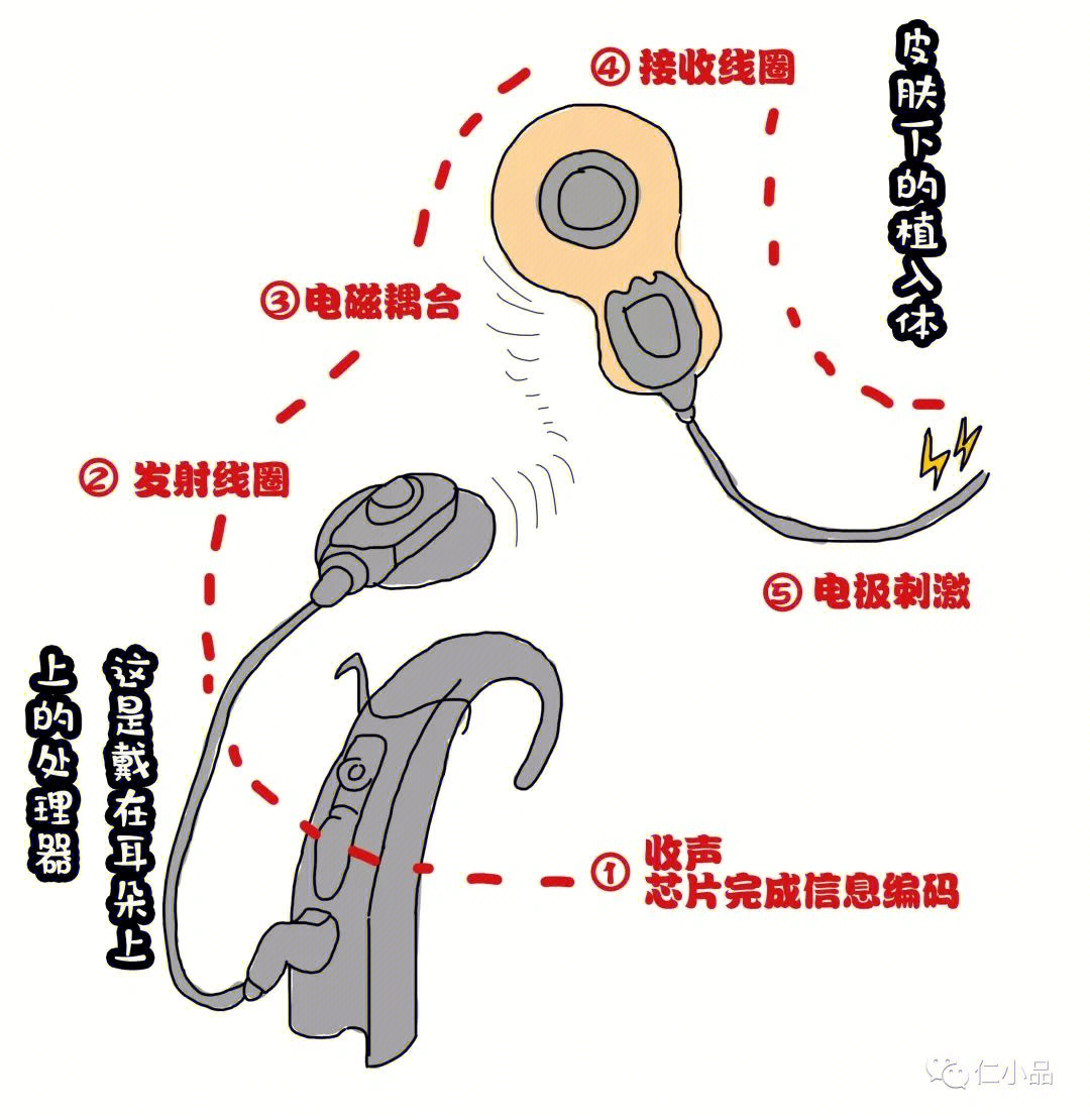 大前庭何种情况下需要考虑做人工耳蜗