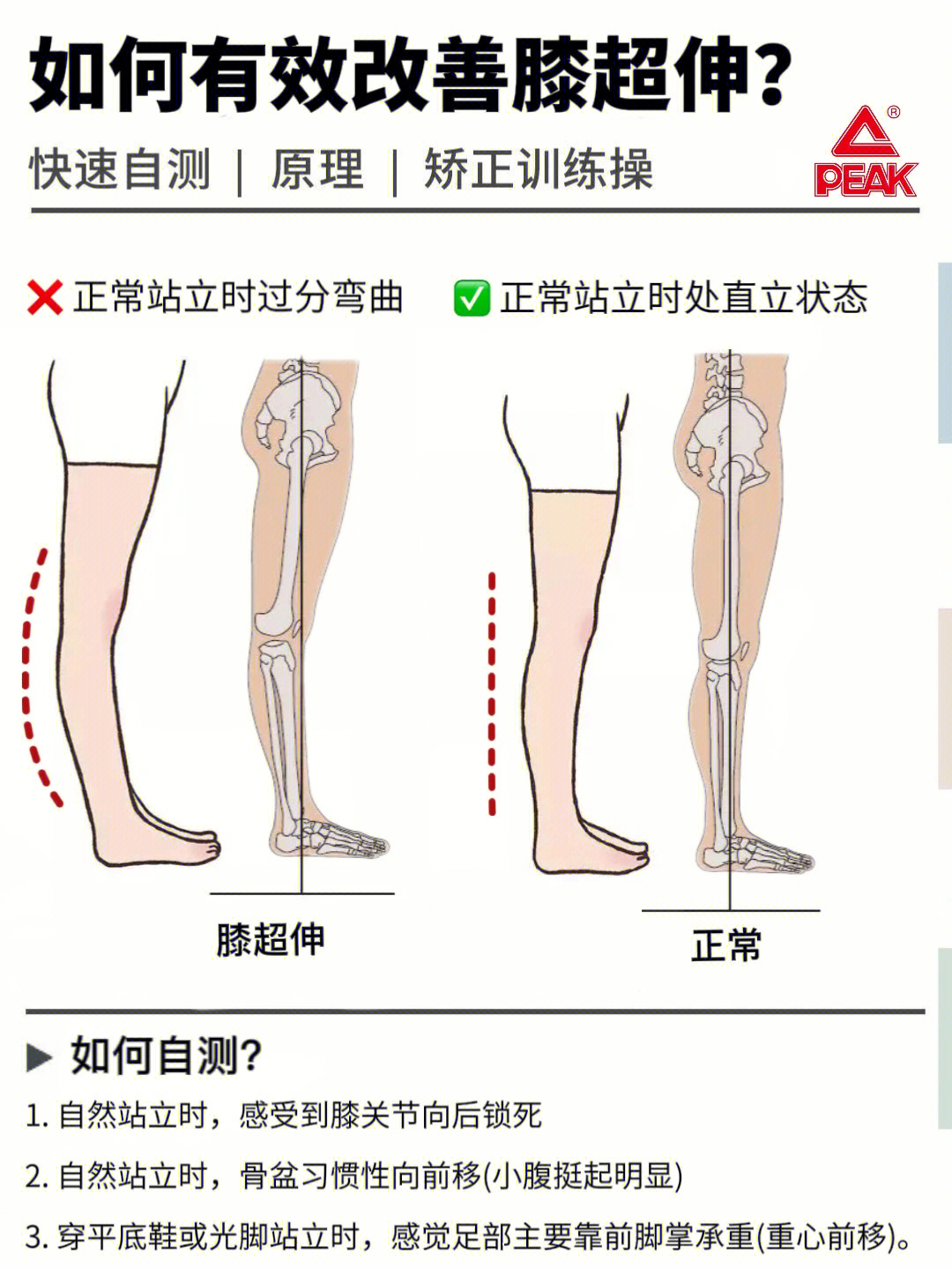 膝超伸怎么改善图片