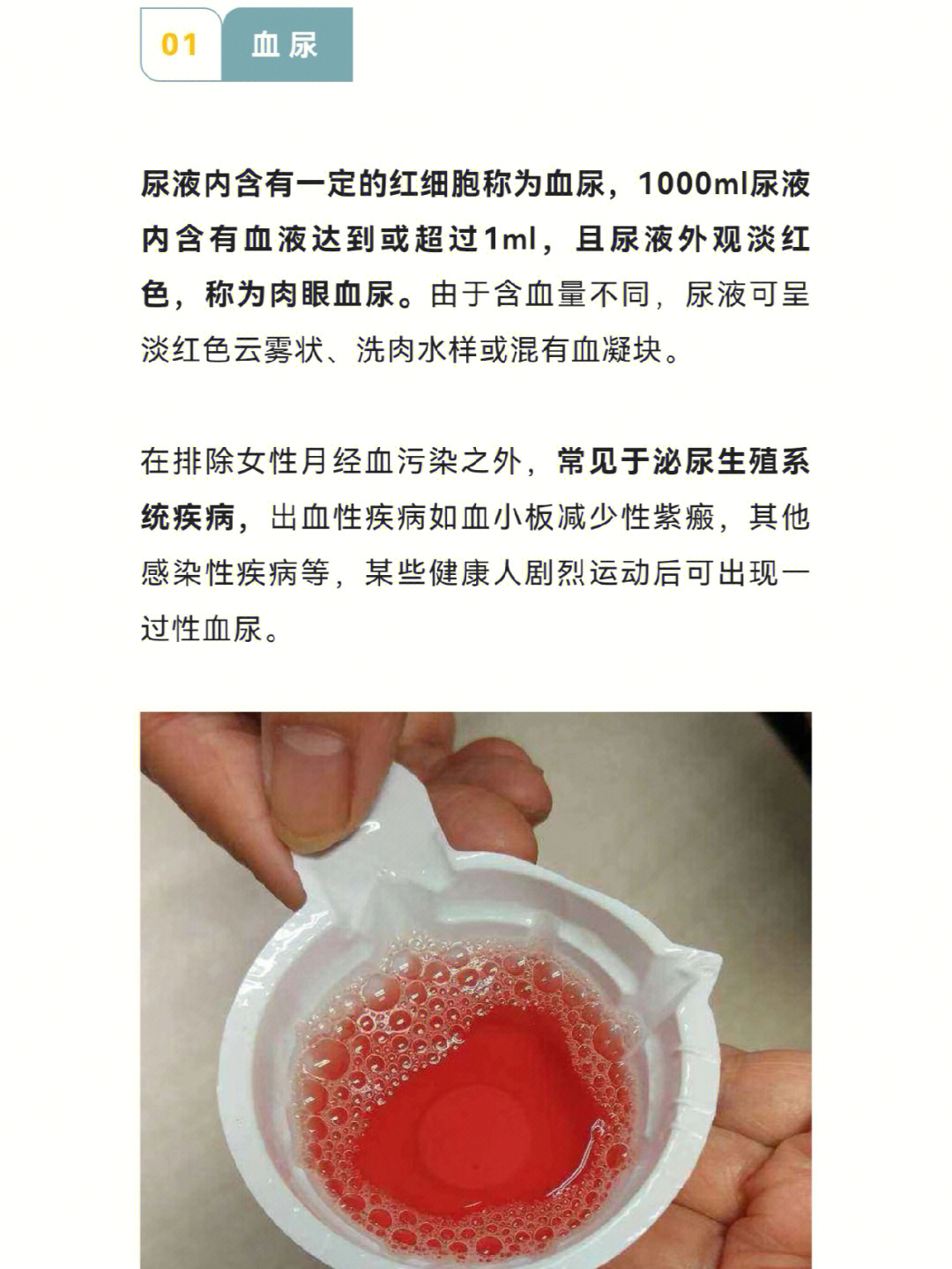 黄褐色尿正常吗图片