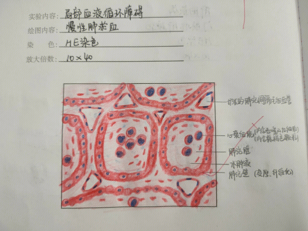 子宫平滑肌瘤红蓝铅笔图片