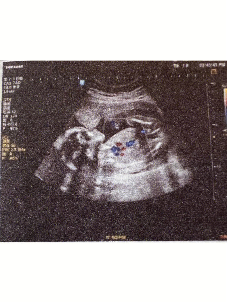 七个月引产的胎儿图片图片