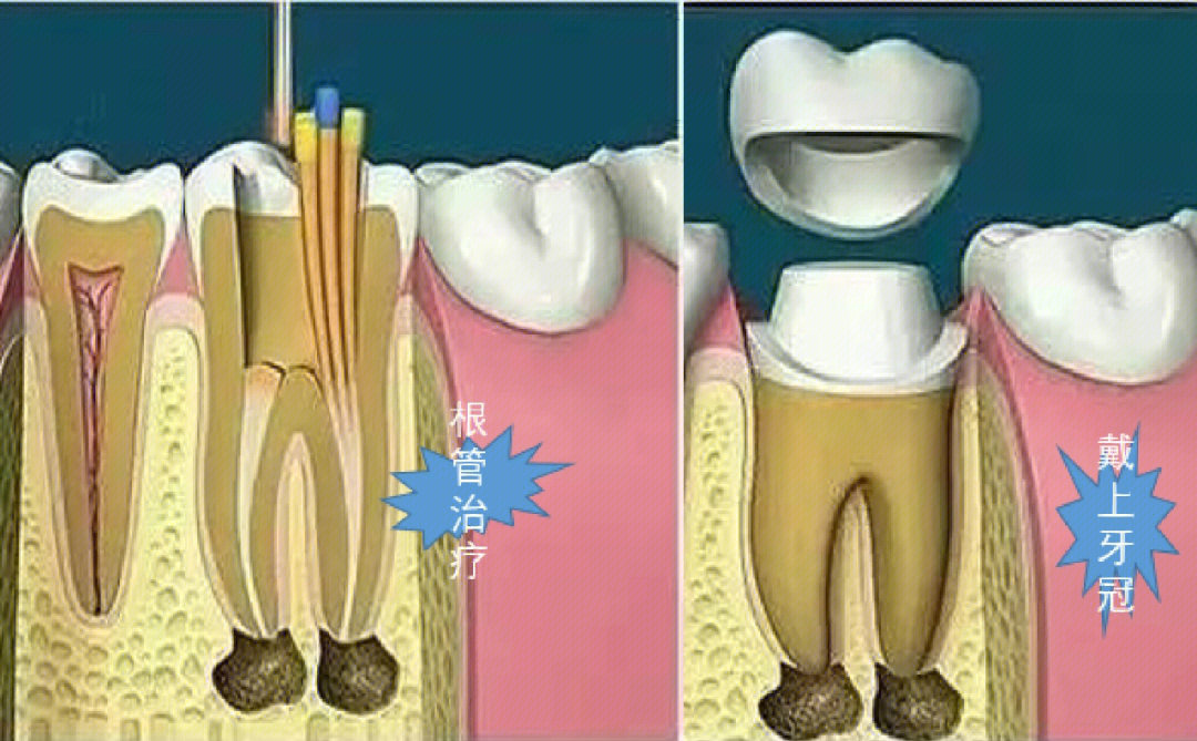 慢性牙髓炎怎么治疗图片