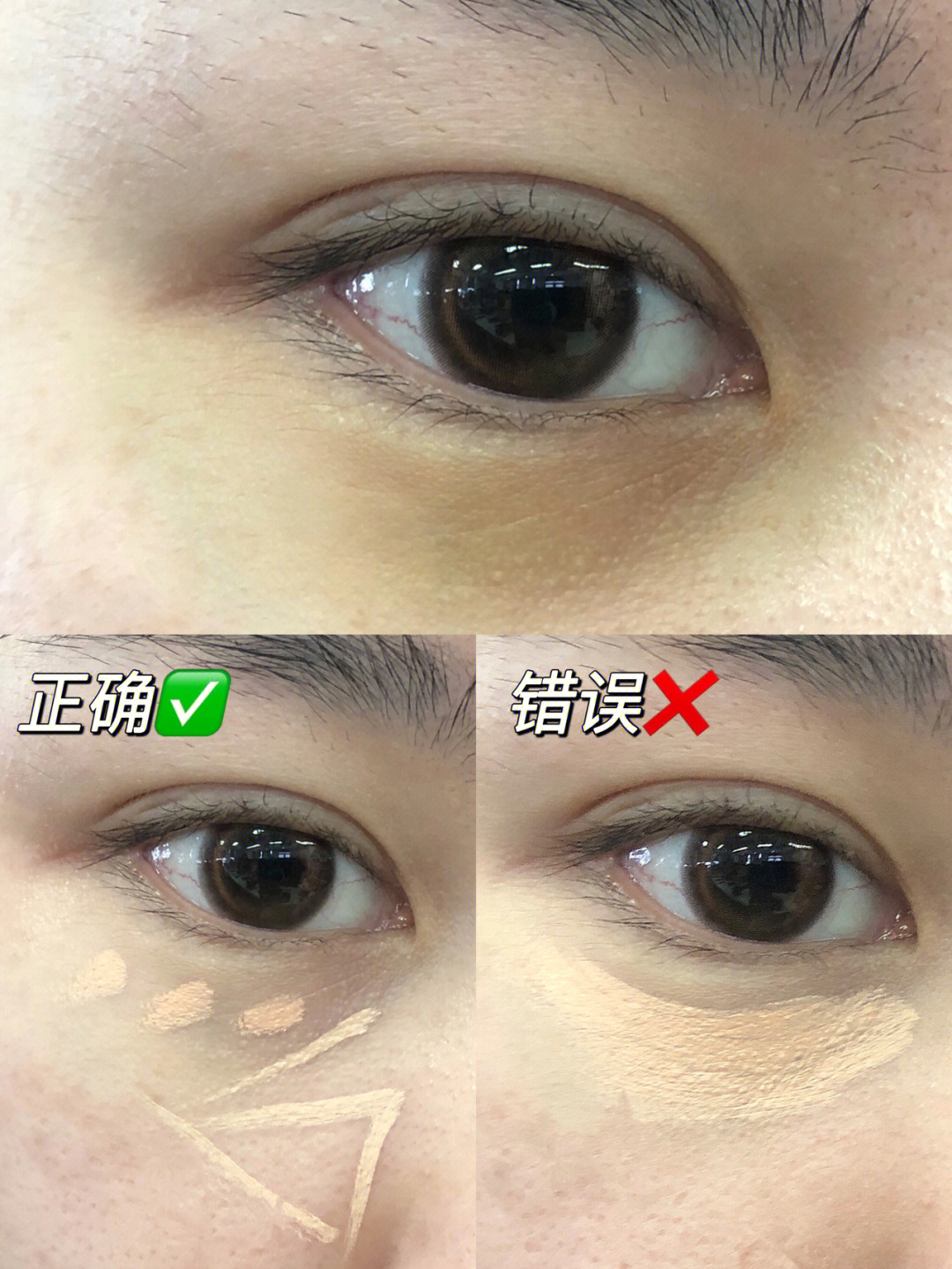 结构型黑眼圈怎么改善图片
