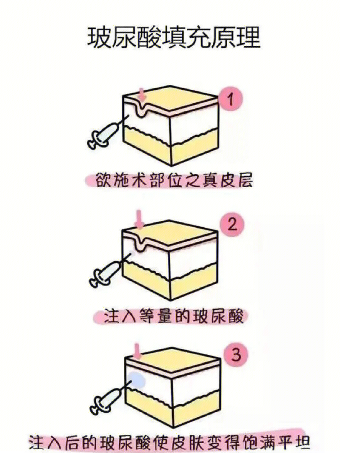 玻尿酸注射原理图片