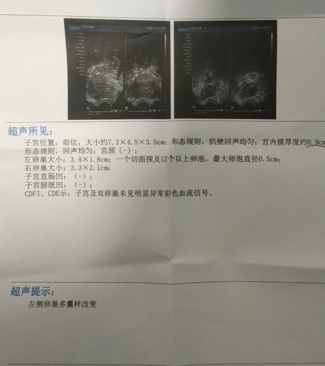 多囊卵巢综合症化验单图片